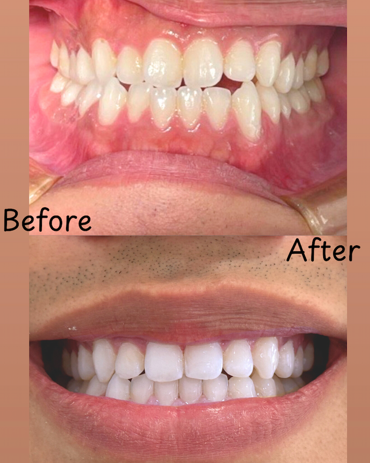 Before and after Invisalign result 3